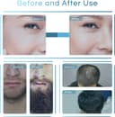 Thumbnail 3 de Dr.roller Derma Stamp Microneedling Pen 0-3mm 140 Pins 📷