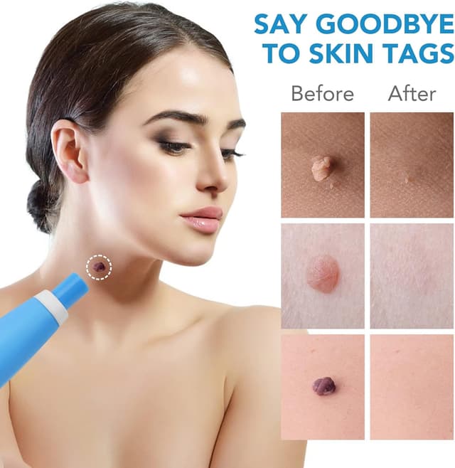 Detalle 2 de Skin Tag Removal Kit 40 bands 🩺