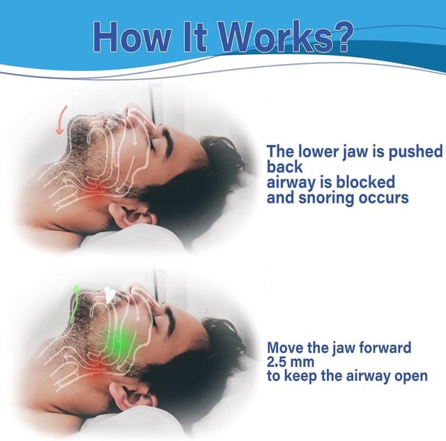 Detalle 2 de Anti Snoring Mouthpiece with 180 Open Front Design – 2.5 mm jaw adjustment, ready-to-use snore stopper for men and women