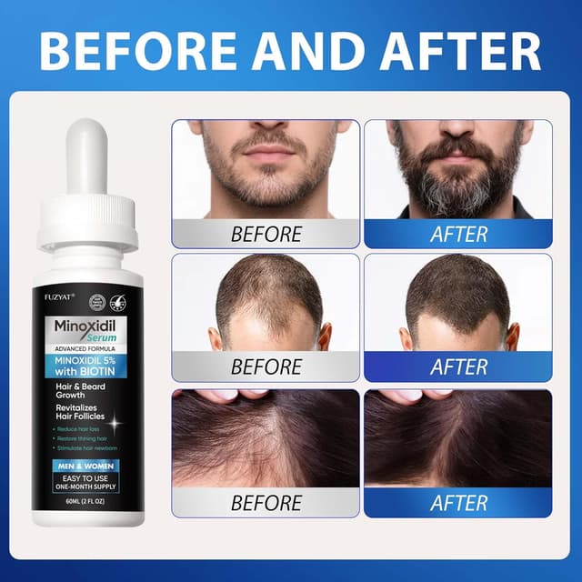 Detalle 2 de 5% Minoxidil Hair Regrowth Serum (Men & Women) with Biotin & Castor Oil — 120ml