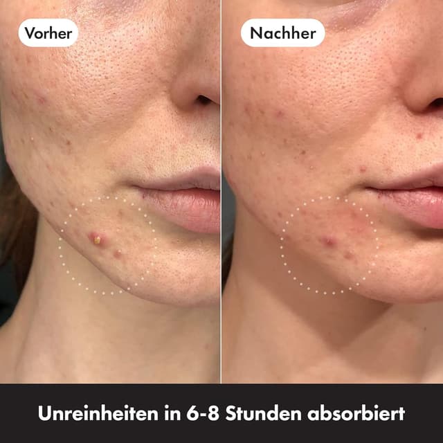 Detalle 2 de Hero Mighty Patch Original 144 Pickel-Patches 🩹