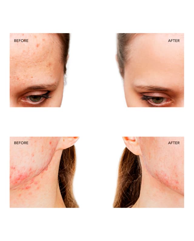 Thumbnail 1 de FOREO ESPADA™ 2 tratamiento para acné Fuchsia 📷