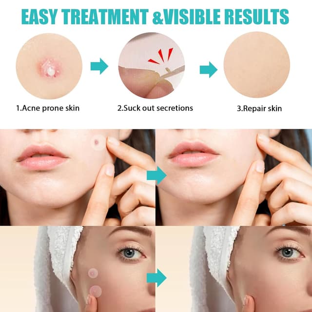 Thumbnail 3 de Pickel Patch 264 Stück Pimple Patches 🩹