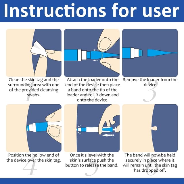 Detalle de Kit de traitement d’acrochordons VFjVlVdG (1 à 9 mm) pour verrues et grains de beauté