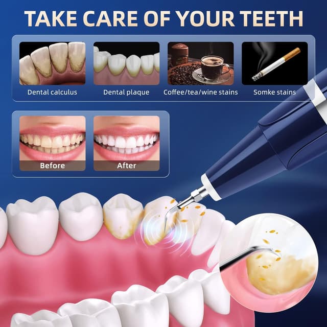 Thumbnail 2 de Plaque Remover 1500 mAh 🪥