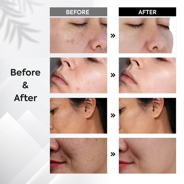 Detalle de Pigmentflecken Entferner Gesicht Anti Pigment Dark Spot Correcting Glow Serum mit Niacinamid & Vitamin C