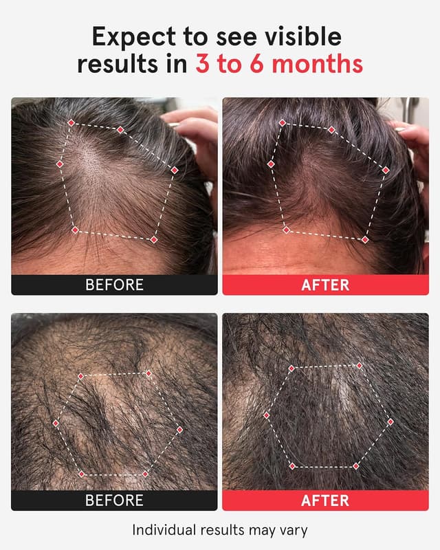 Thumbnail 1 de iRestore Pro Red Light Therapy System