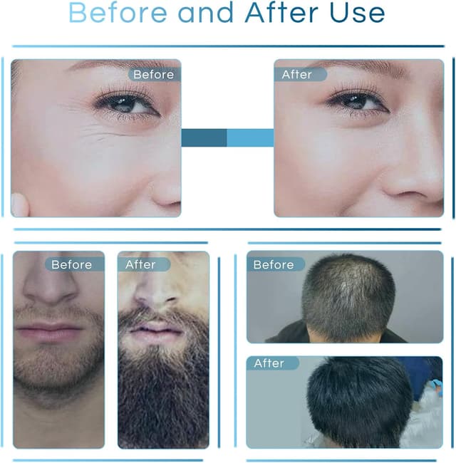 Thumbnail 3 de Dr.roller Derma Stamp Microneedling Pen 0-3mm 140 Pins