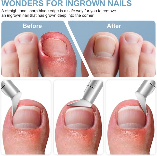Thumbnail 2 de Nagelknipser für eingewachsene Zehennägel