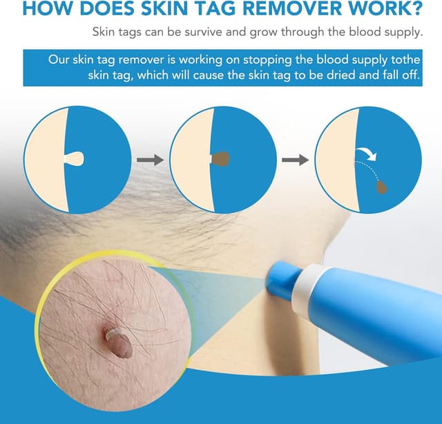 Detalle 2 de Skin Tag Removal Kit 40 bands 🩺