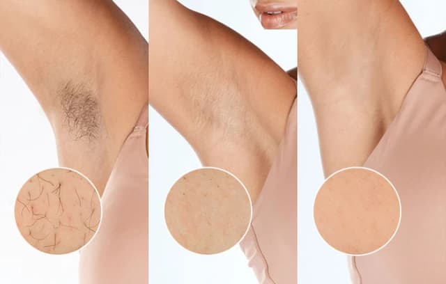 Detalle de Philips Lumea IPL 9900 Series BRI951/01 für präzises IPL