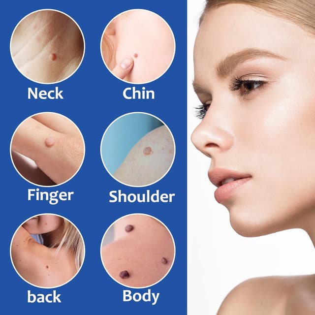 Thumbnail 6 de Kit de traitement d’acrochordons VFjVlVdG (1 à 9 mm) pour verrues et grains de beauté