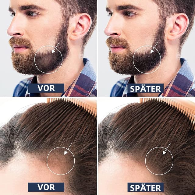 Detalle 2 de Beard Roller 0,5 mm Derma Roller 🧔