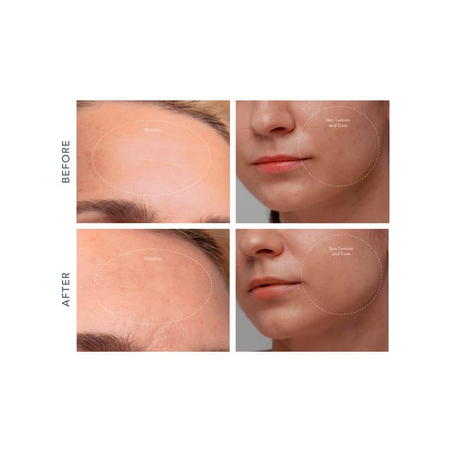 Thumbnail 4 de FOREO KIWI™ derma Microdermoabrasión Adamas y aspiración de poros