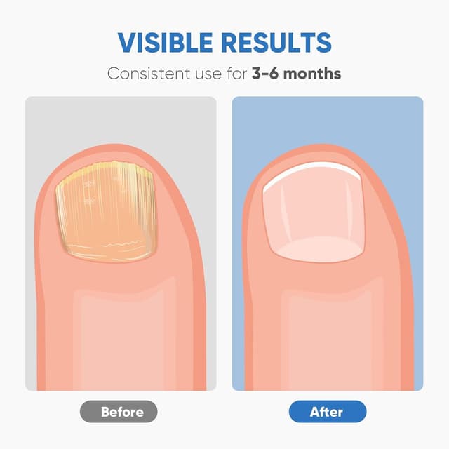 Thumbnail 2 de Berrlly Láser 460nm para Hongos en Uñas 🦶 Fácil y Efectivo