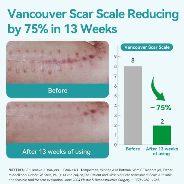 Detalle de Dimora Medical Grade Silicone Scar Sheets (4cm x 3m) for waterproof scar treatment