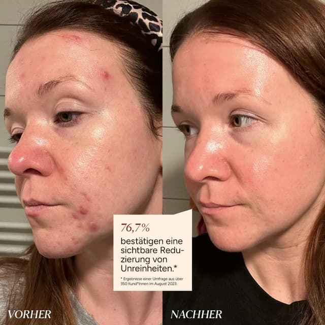 Thumbnail 1 de JUNGLÜCK Azelain Serum 10% Azelainsäure