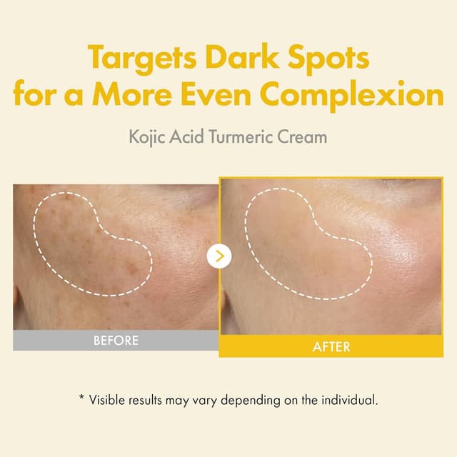 Detalle 2 de TOSOWOONG Kojic Acid Turmeric Cream (99% Kojic Acid), 50ml dark spot and uneven tone corrector