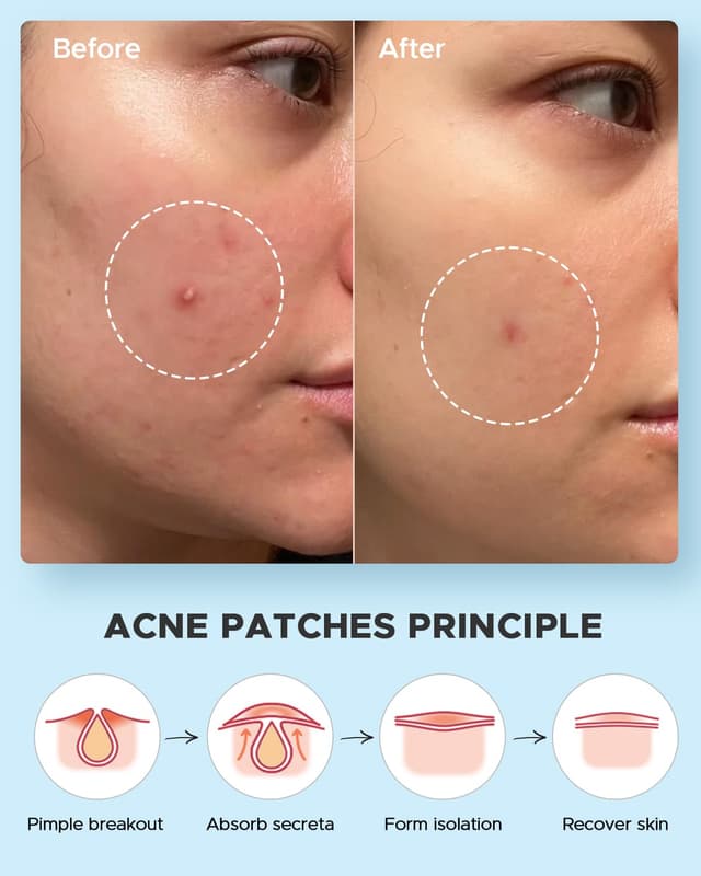 Thumbnail 6 de LitBear Acne Pimple Patches 588 Dots