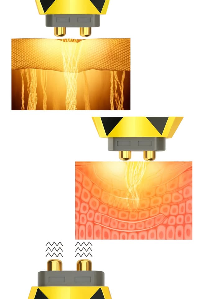 Thumbnail 3 de Drakefor DKF-DIAMOND RF EMS FOTON — dispositivo radiofrecuencia 1 sesión