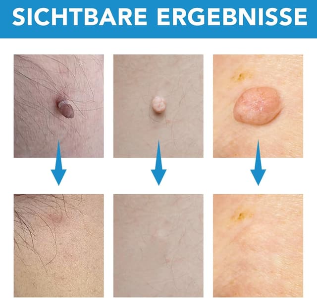 Thumbnail 5 de CFHQXSZ Skin Tag Removal Kit 40 Bands