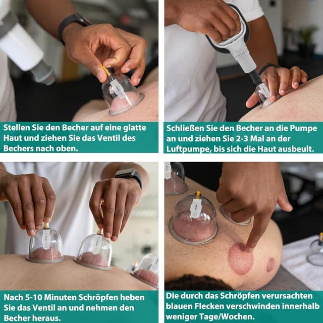 Thumbnail 2 de 24 Stück Schröpfgläser mit Vakuumpumpe