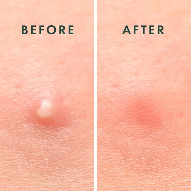 Detalle de Rael Miracle Invisible Spot Cover Hydrocolloid Acne Spot Patches (96 count, 2 sizes)