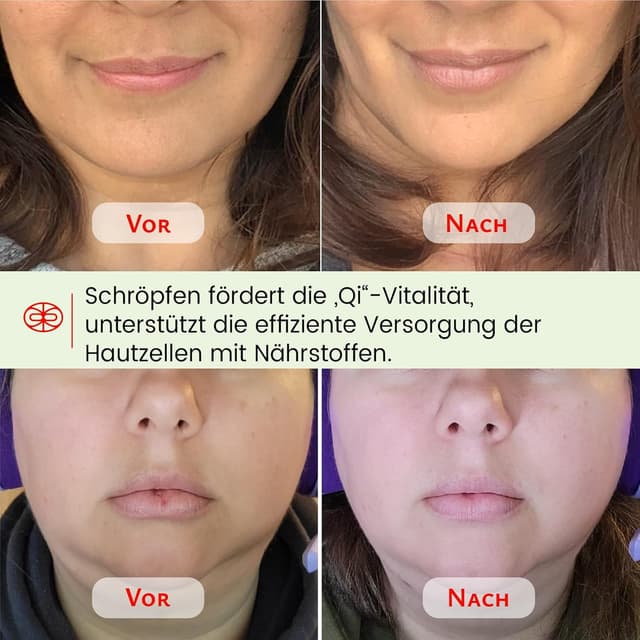 Detalle de Rena Chris Ventosaterapie Set 2 Silikon-Gläser