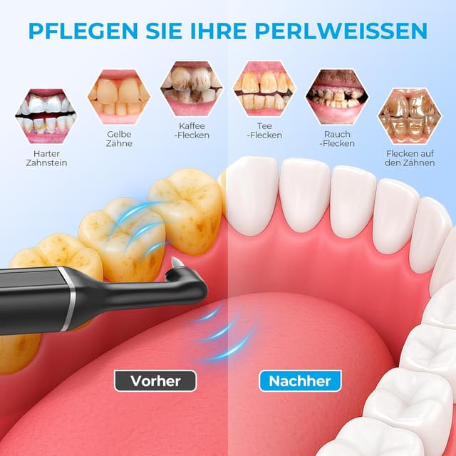 Detalle 2 de Zahnsteinentferner Zahnaufhellungsset „Professionell“ mit Zahnpolierer, 5 Modi und LED (5 Köpfe, Type-C, IPX7)