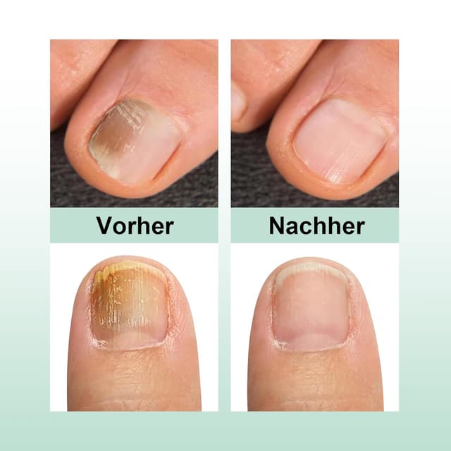 Detalle 2 de Nail Care Pen 2er-Set: Das Original Nail Care Pen für Fingernägel & Fußnägel