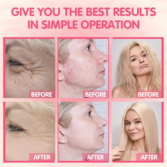 Detalle 2 de TUMAKOU Hochfrequenzstab Gesichtsmassagegerät mit 4 Stäben