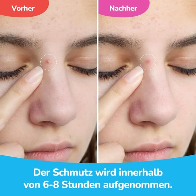 Detalle de Bagavs Pickel Patch Acne Patch 72 Stück