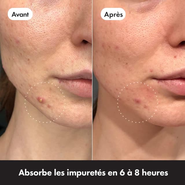 Thumbnail 4 de Hero Cosmetics Mighty Patch Invisible+ anti-imperfections