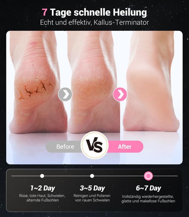 Thumbnail 6 de GZCHENHAO 9.0 Hornhautentferner elektrisch für Füße