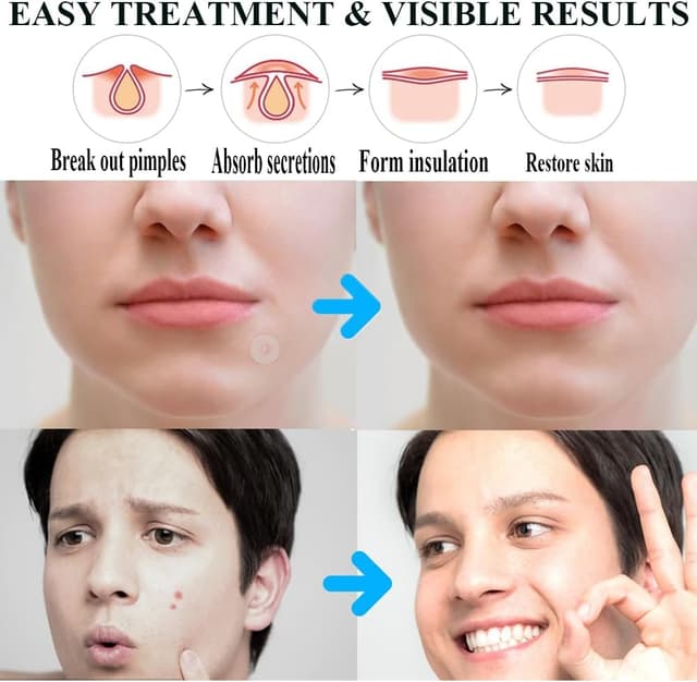 Thumbnail 5 de Zemolo 300 Parches para Granos Hidrocoloides