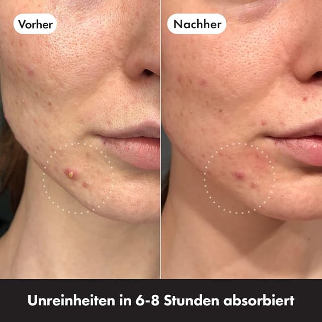 Detalle 2 de HERO COSMETICS Mighty Patch Invisible+ Pickel‑Patches 78 🩹