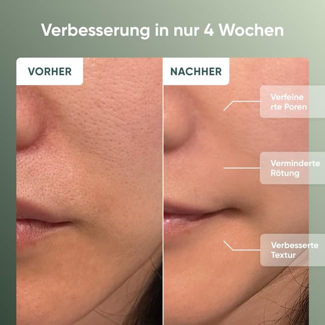 Thumbnail 6 de Nanoleaf LED-Lichttherapie-Gesichtsmaske mit 7 Modi, tragbare Rotlichtmaske & NIR-LEDs