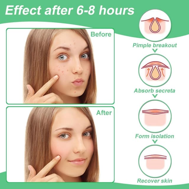 Thumbnail 3 de Zebrlan 300 Stück Pimple Patches 300 Stück