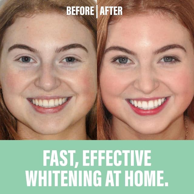 Detalle de Spotlight Oral Care Teeth Whitening Strips (28 strips + toothpaste) – 14-day hydrogen peroxide kit for sensitive teeth