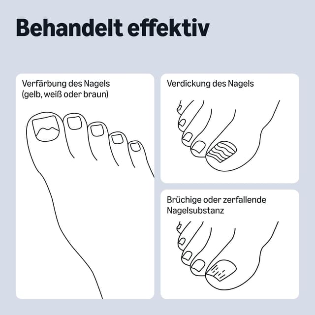 Detalle 2 de Healthcare by Amazon Flüssigkeit gegen Nagelpilz (10 ml) – mit Harnstoff, Teebaumöl und Milchsäure