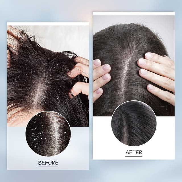 Detalle de Kopfhautpeeling Tiefenreinigung gegen Schuppen