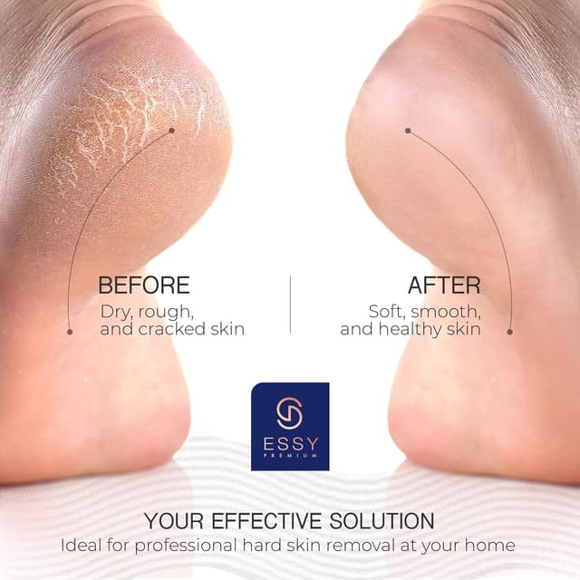 Detalle de Essy elektrischer Hornhautentferner mit 5 Ersatzrollen (blau) – elektrisches Pediküre-Set für die Fußpflege