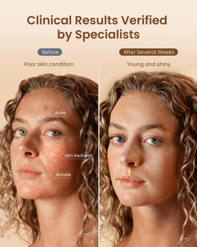 Detalle 2 de Renpho LED Face Mask 324 LEDs