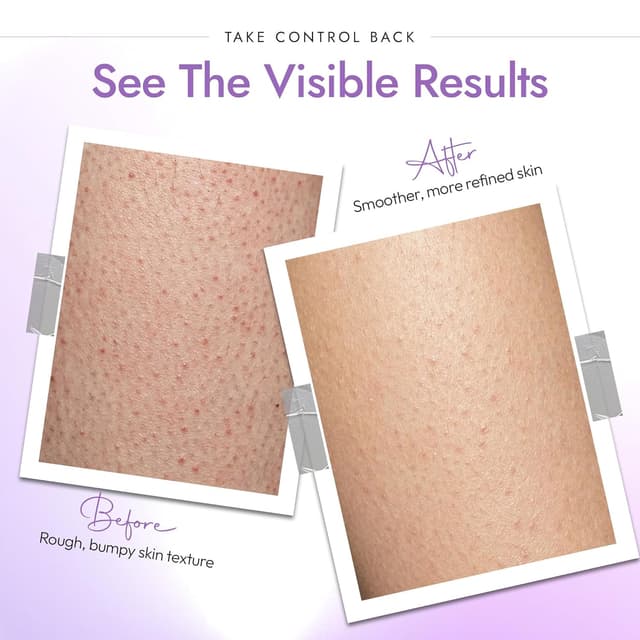 Detalle 2 de DERMAdoctor KP Bump Eraser Body Scrub with 10% AHAs + PHAs (Glycolic & Lactic acids) — 16 fl oz