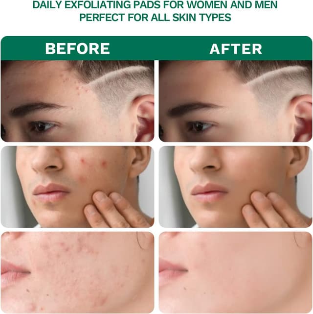 Detalle 2 de ANAiRUi Dischetti esfolianti all’acido salicilico 2% per il viso, 80 pads