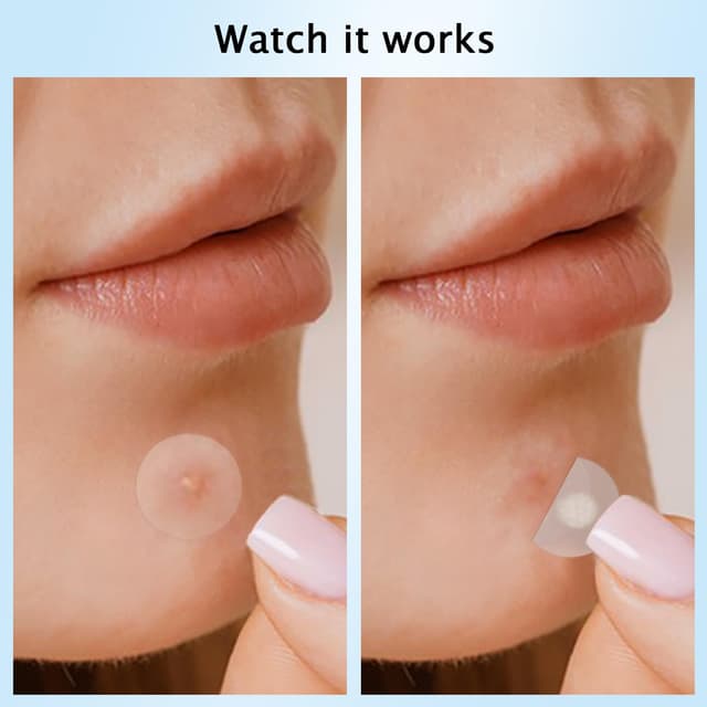 Thumbnail 4 de 360 Stück Pickel Patch Hydrokolloid 🩹