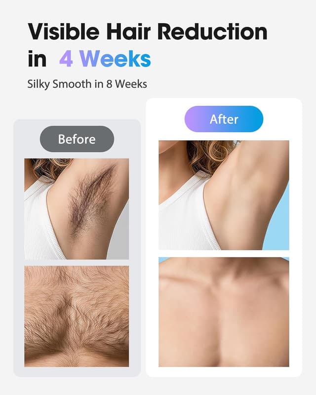 Detalle de Haarlosy IPL Laser Hair Removal Device with Ice Cooling (999,900 flashes) for Face, Bikini Line & All Body