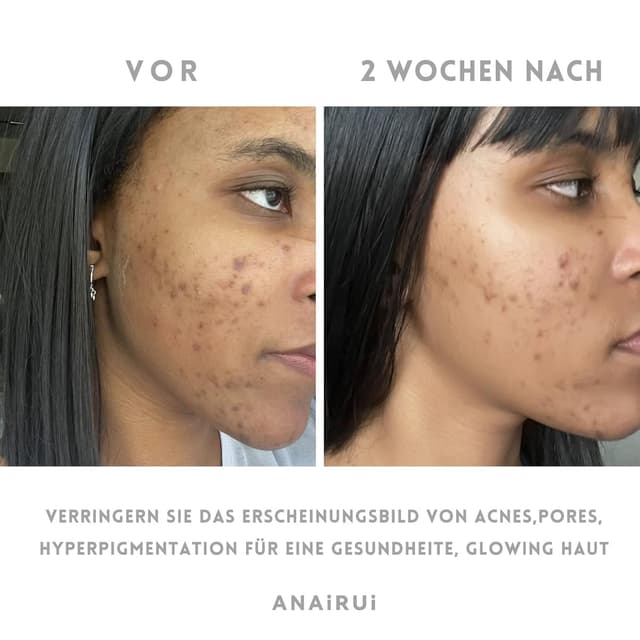 Detalle de ANAiRUi Kurkuma Vitamin C Tonmaske für das Gesicht (120 g) – reinigt, beruhigt und unterstützt bei ungleichmäßigem Hautton