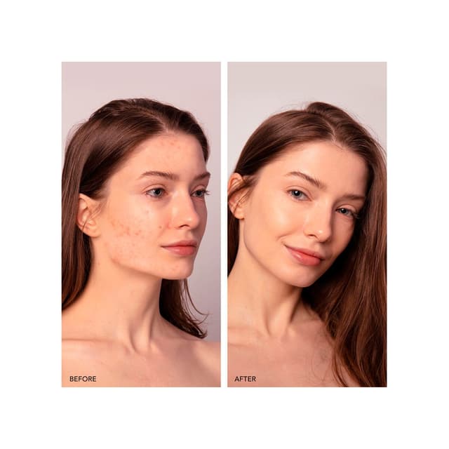 Thumbnail 3 de Foreo Espada™ 2 plus tratamiento acné🔬