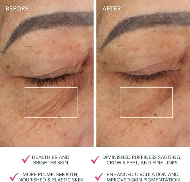 Thumbnail 4 de FOREO Bear massaggiatore viso antiage 5 livelli